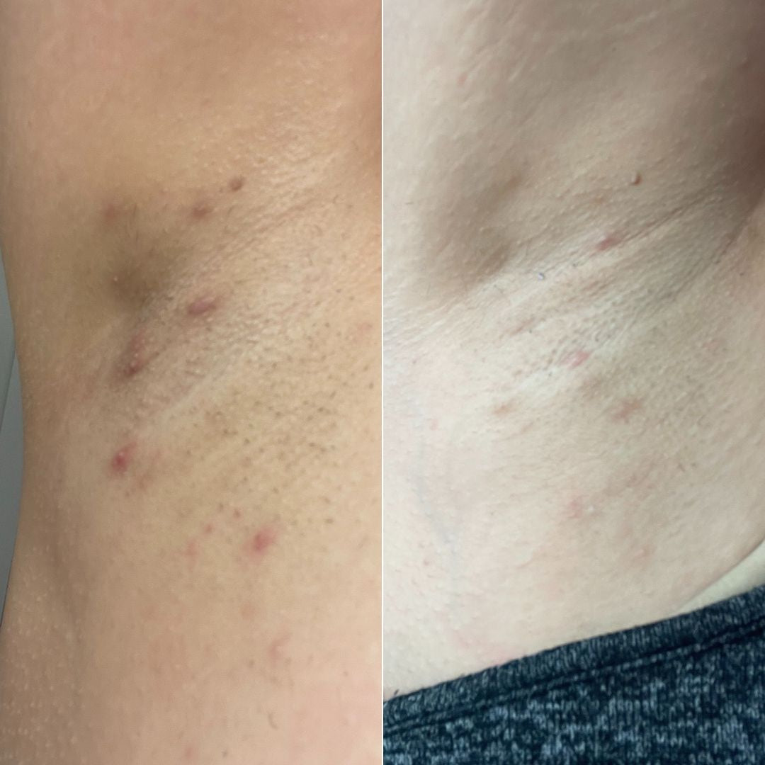 Crema Como Curar Los Granos Despues De La Depilacion Eliminar